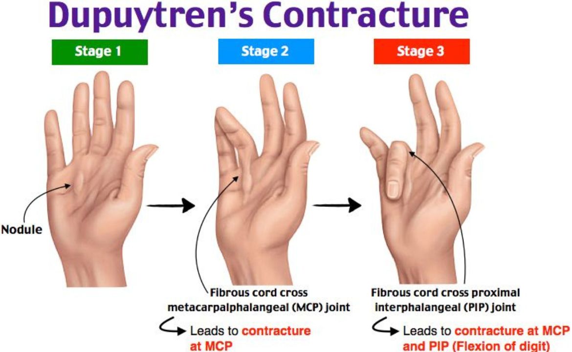 Dupuytren's Contracture: Problems, Causes and Treatment Guide