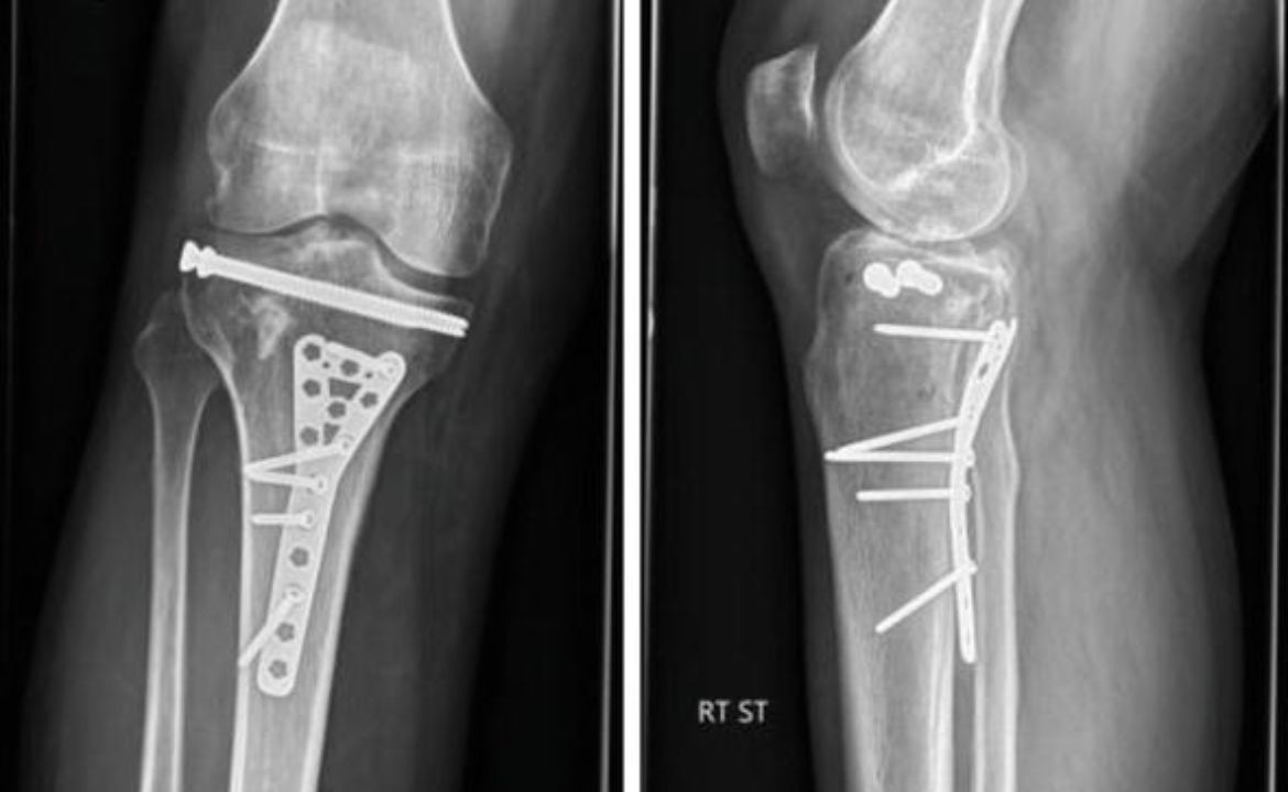 Tibial Plateau Fracture: Causes and Treatments
